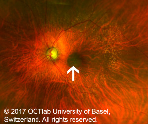 Central, dark pigmented choroidal tumor. © 2017 OCTlab University of Basel, Switzerland. All rights reserved.