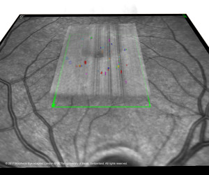 Segmentation of microcysts in MACTEL. © 2017 OCTlab University of Basel, Switzerland. All rights reserved.