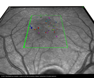     Segmentation of microcysts in MACTEL. © 2017 OCTlab University of Basel, Switzerland. All rights reserved.